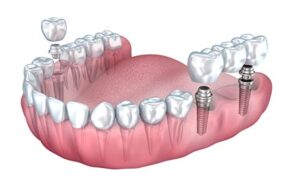Dental Implants in Irving, Texas
