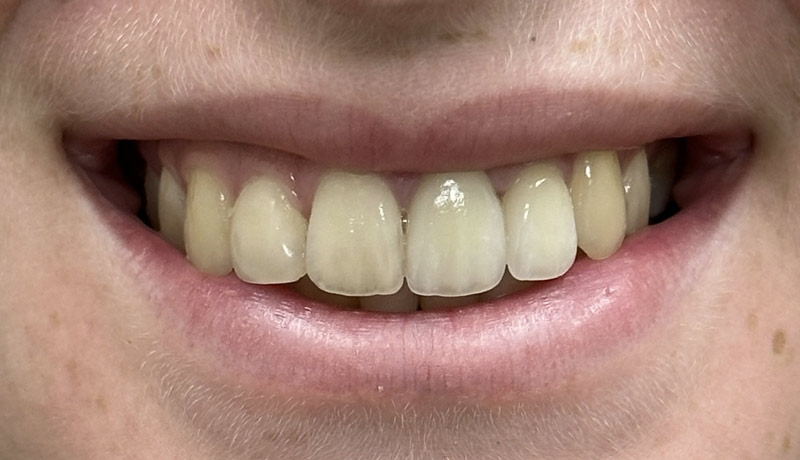 After Dental Crown and Bonding