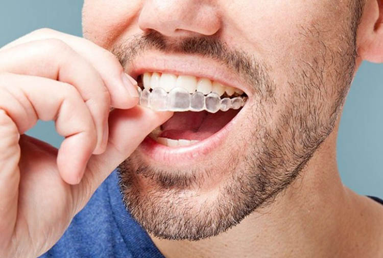 Invisalign Clear Aligners in Irving, TX