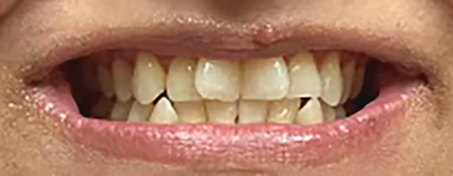 Before Invisalign in Irving, TX