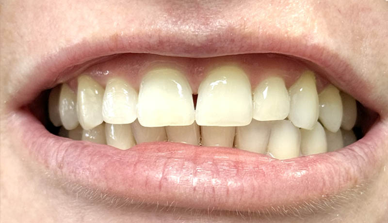 After Internal Tooth Bleaching