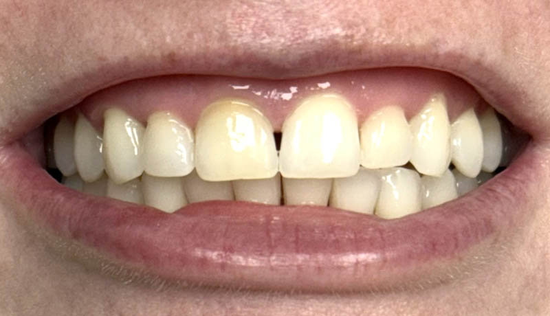 Before Internal Tooth Bleaching