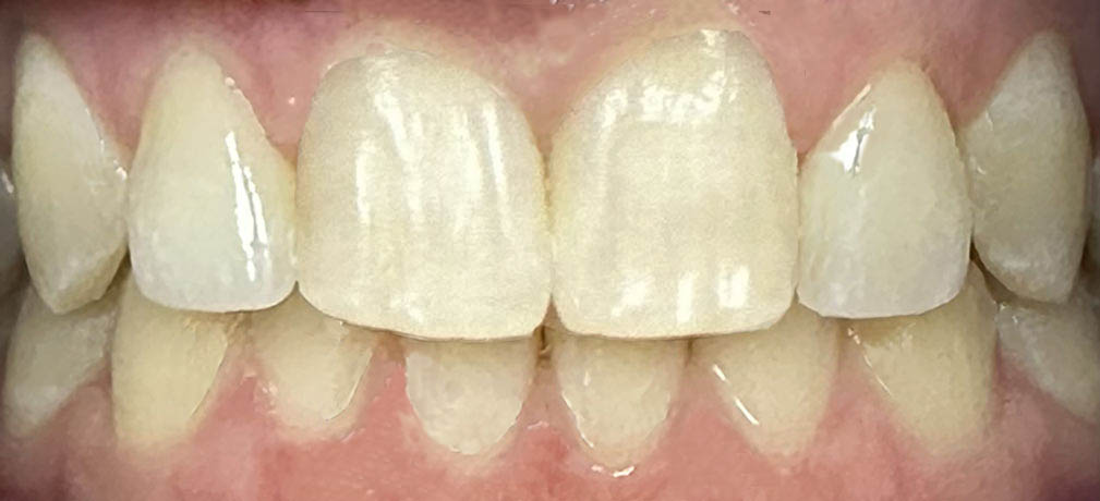 After Dental Crowns Treatment